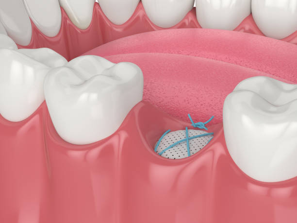 Bone Grafting in Mississauga