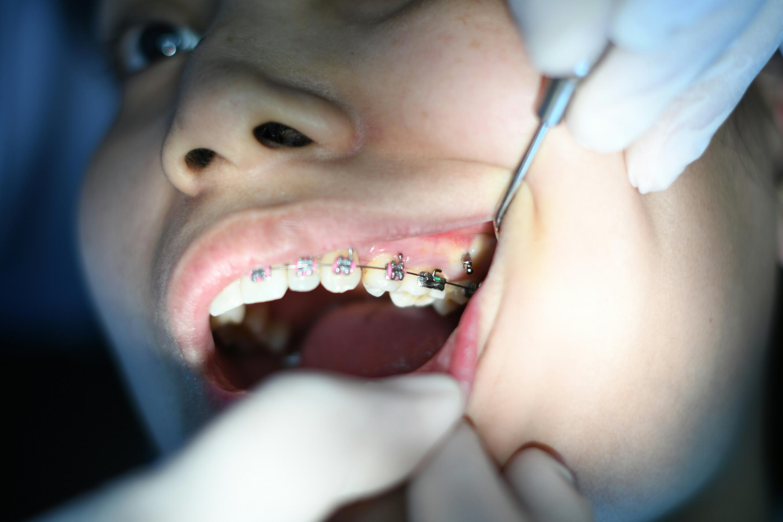 Dental Bonding in Mississauga
