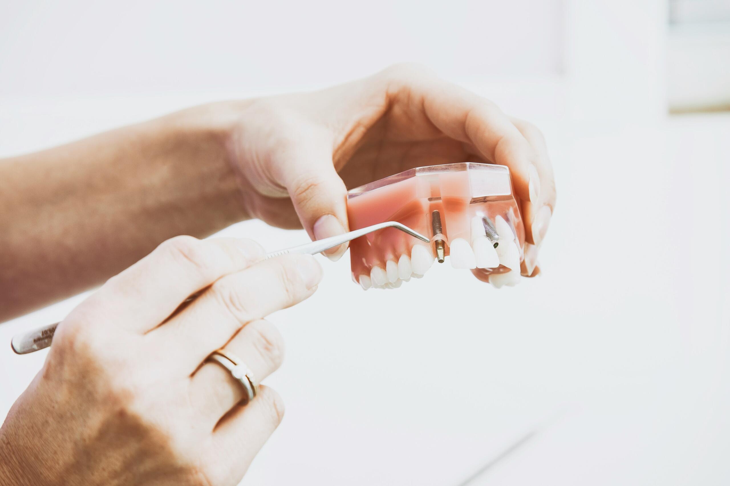 Dental Crowns in Mississauga