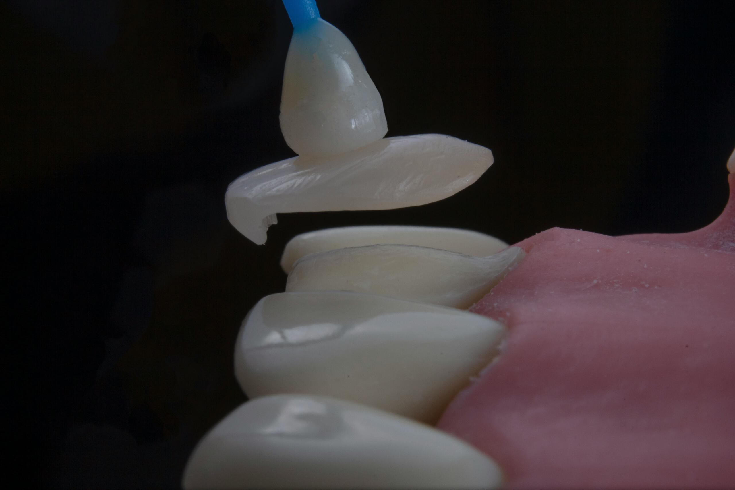 Dental Veneers in Mississauga