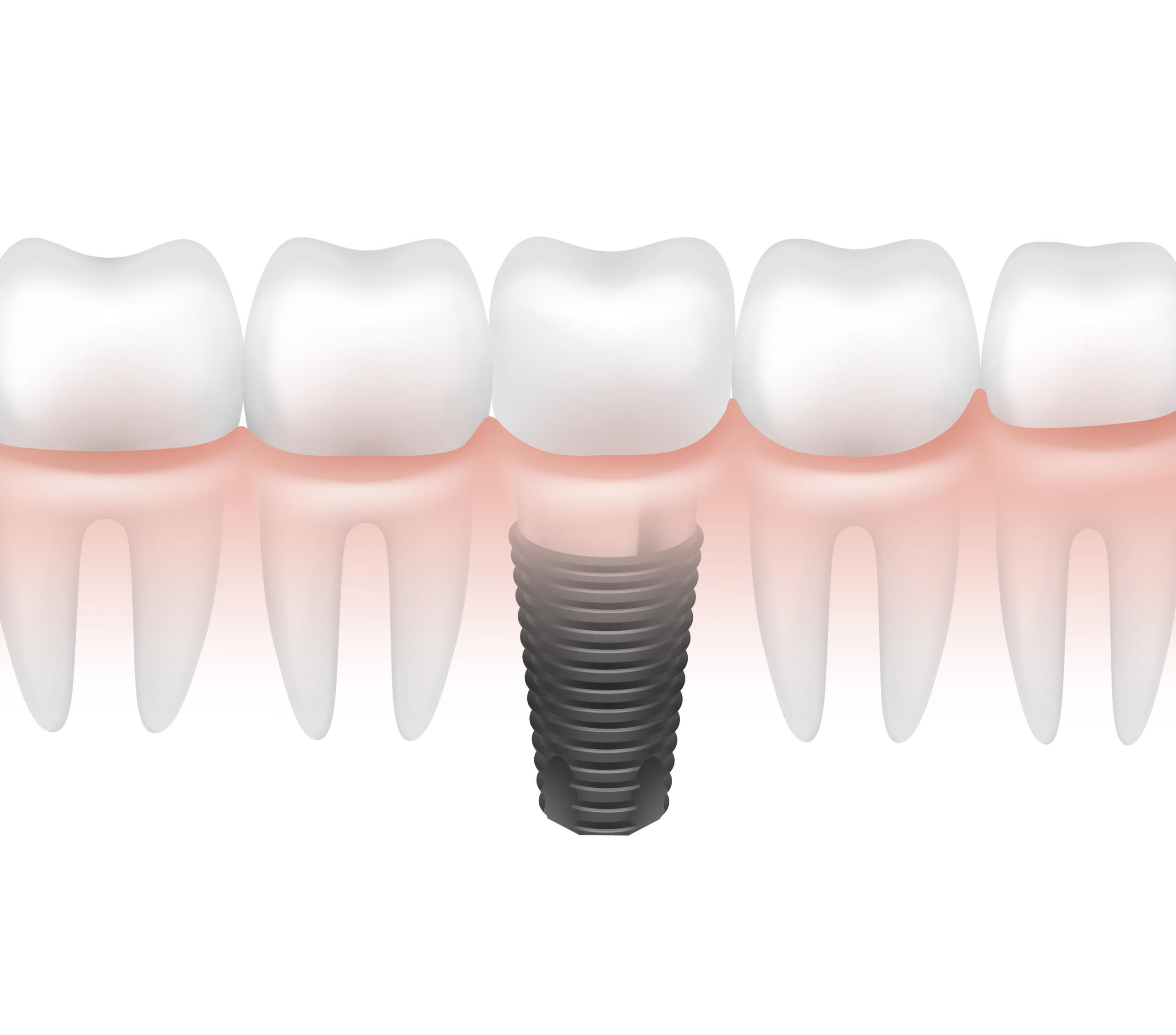 Dental implants in Mississauga