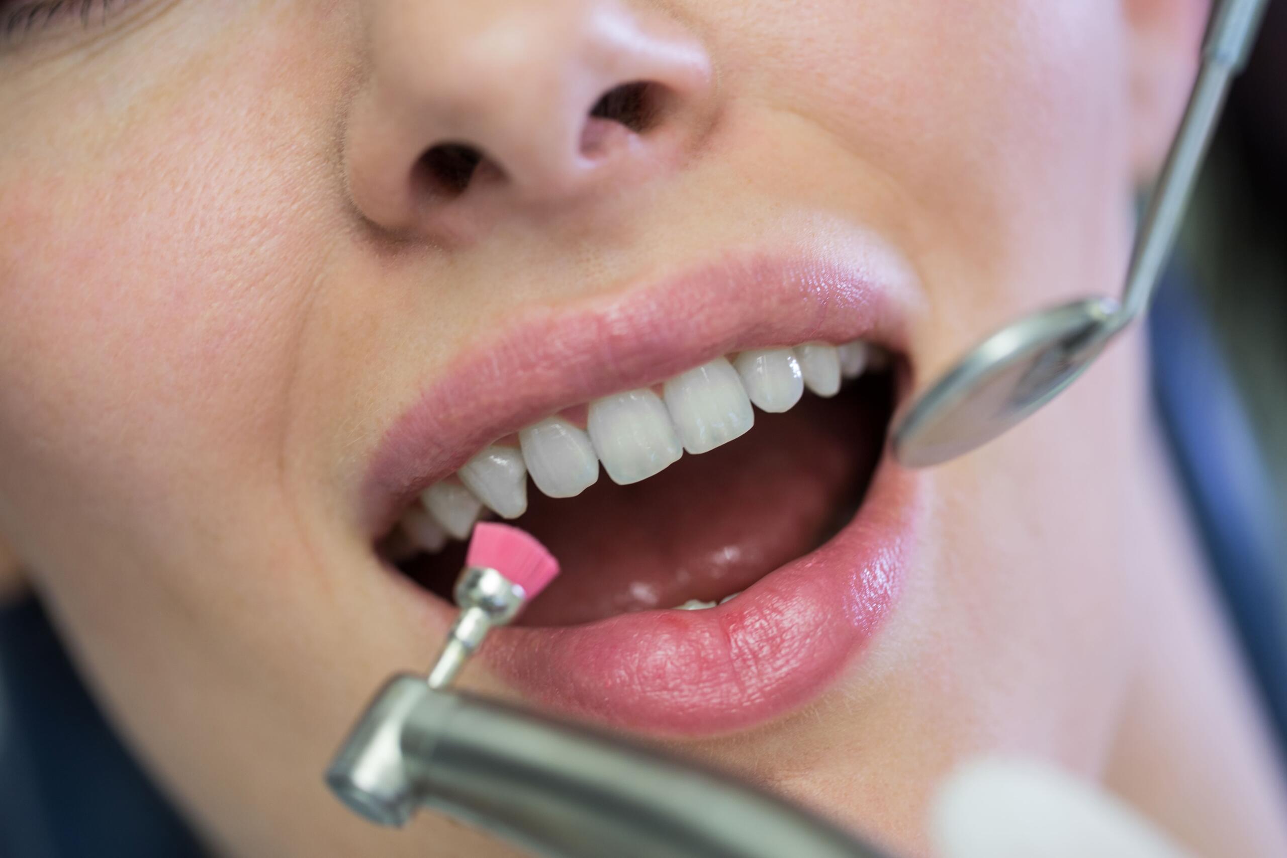 Fluoride Treatment in Mississauga