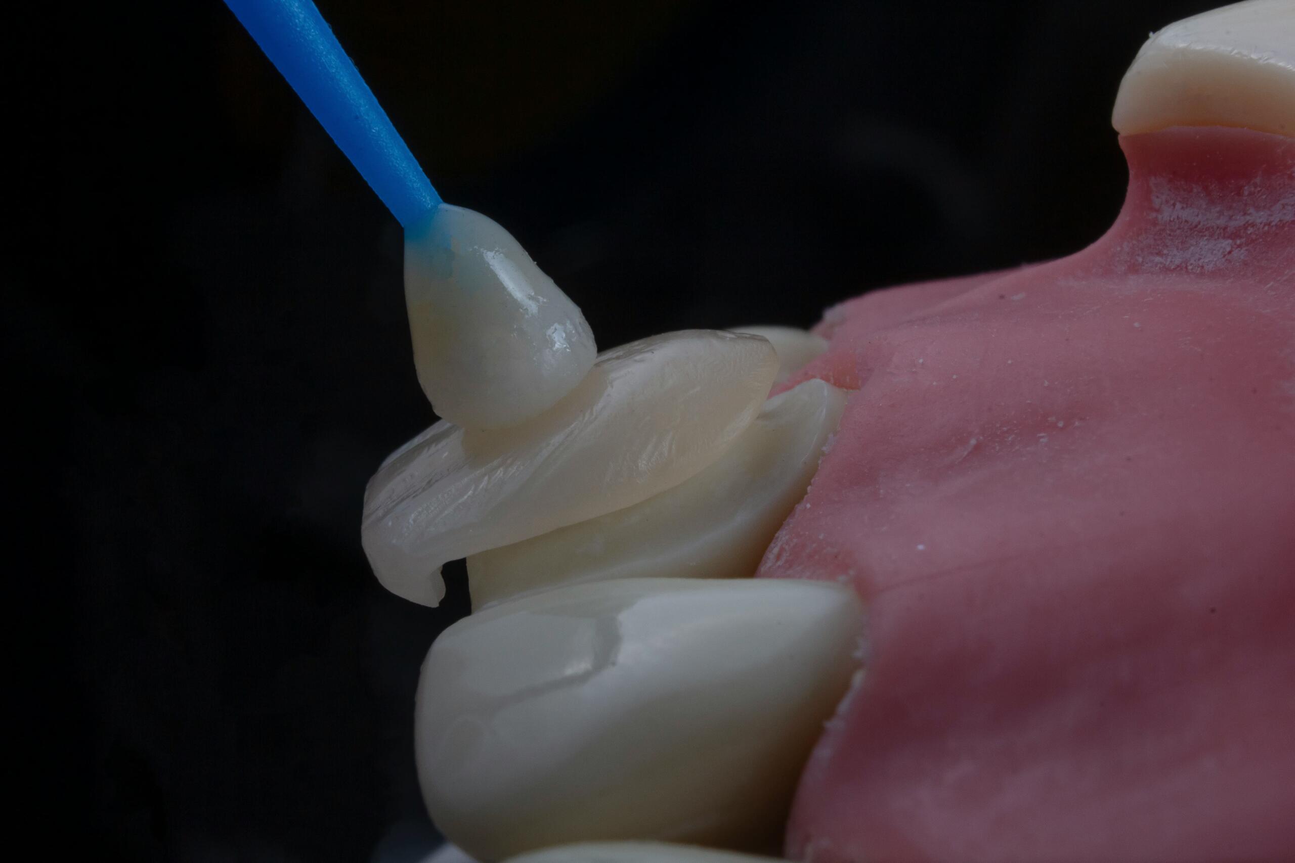 Gum Contouring in Mississauga