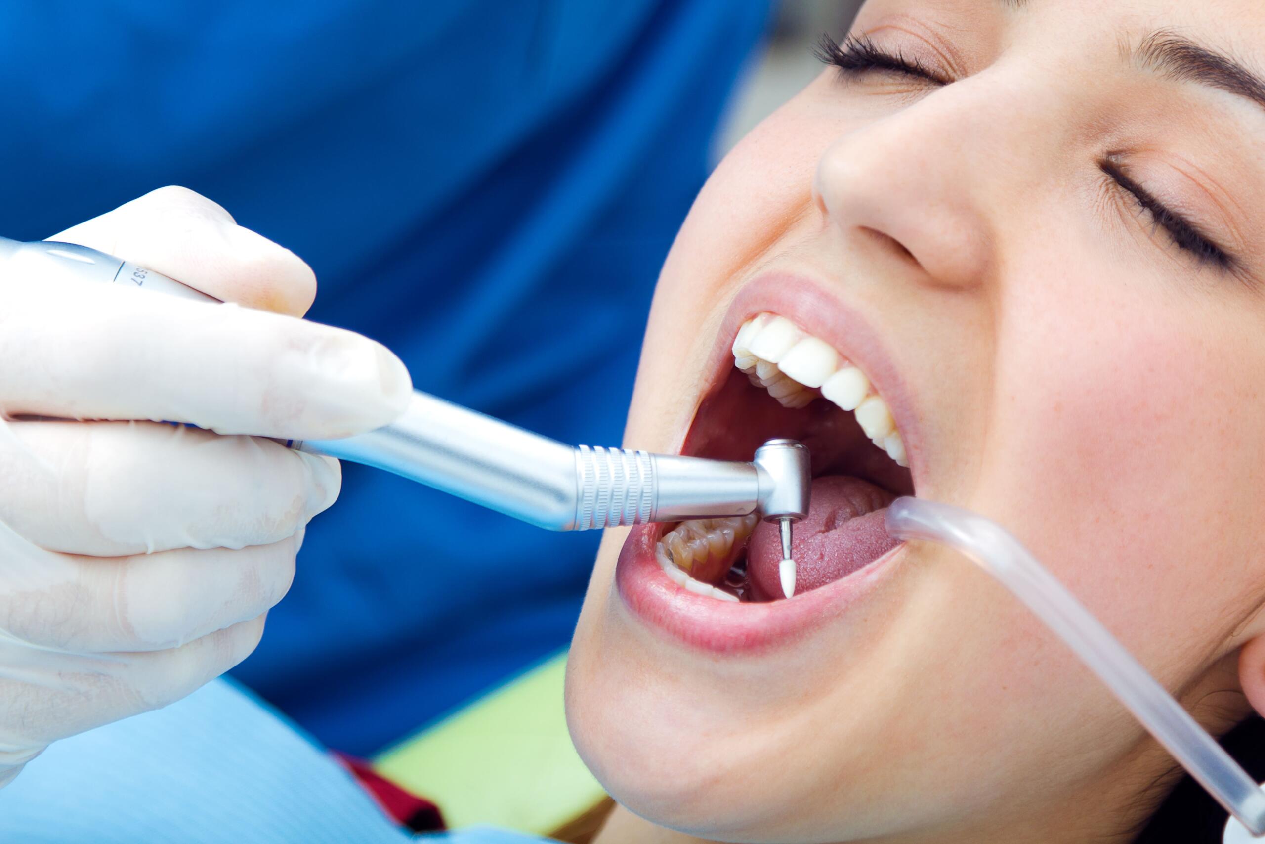 Tooth-Colored Fillings in Mississauga