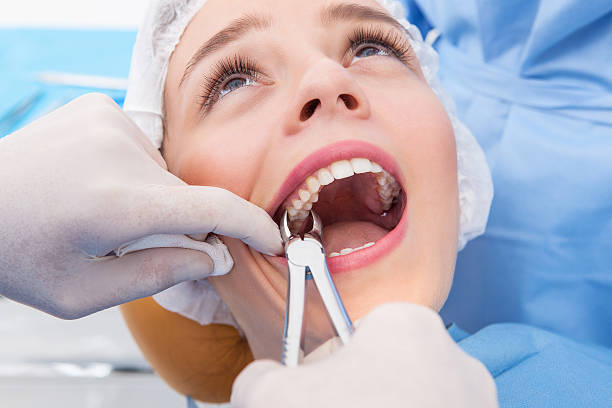Tooth Extraction in Mississauga