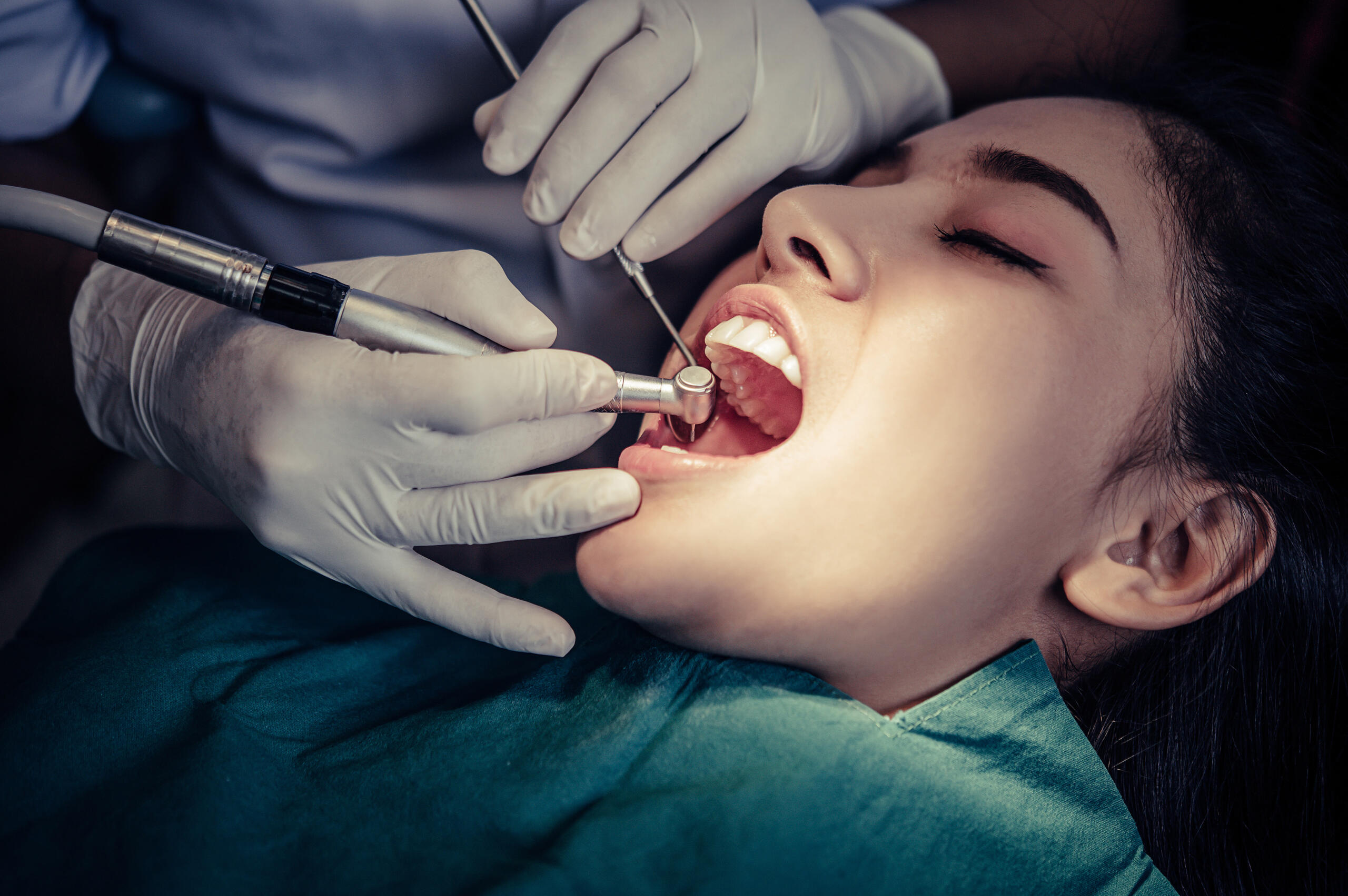 Tooth Extractions in Mississauga