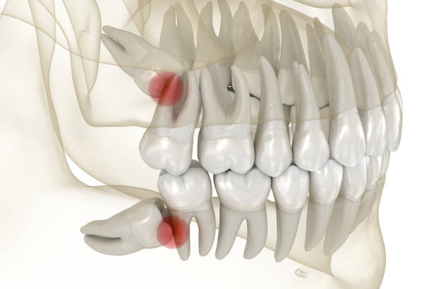 Wisdom Teeth Removal in Mississauga